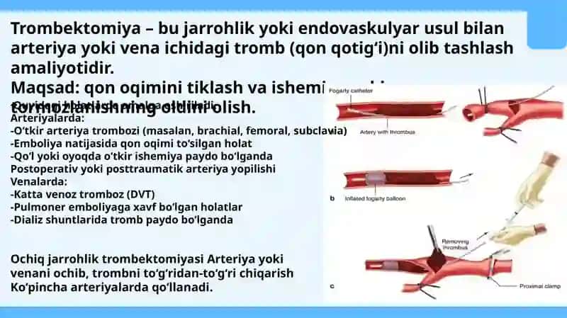 Qo‘l va oyoq qon tomirlarda bajariladigan zamonaviy rekonstruktiv operatsiyalar turlari va texnikasi 2