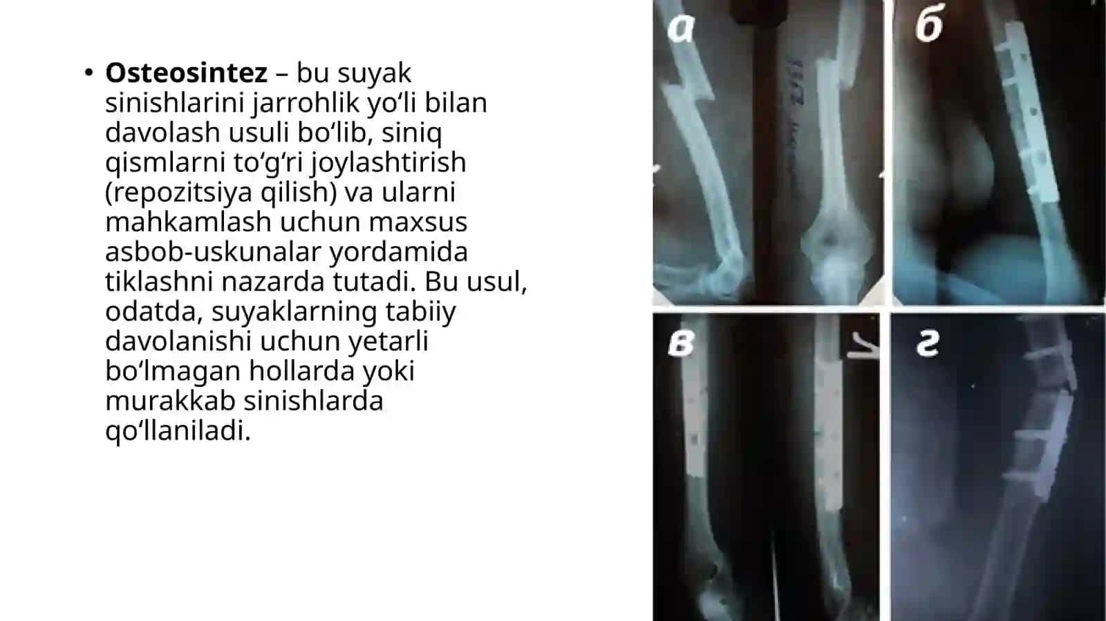 SUYAK SINISHIDABAJARILADIGAN TASHQI VA ICHKIOSTEOSINTEZ JARROHLIK USULI 2