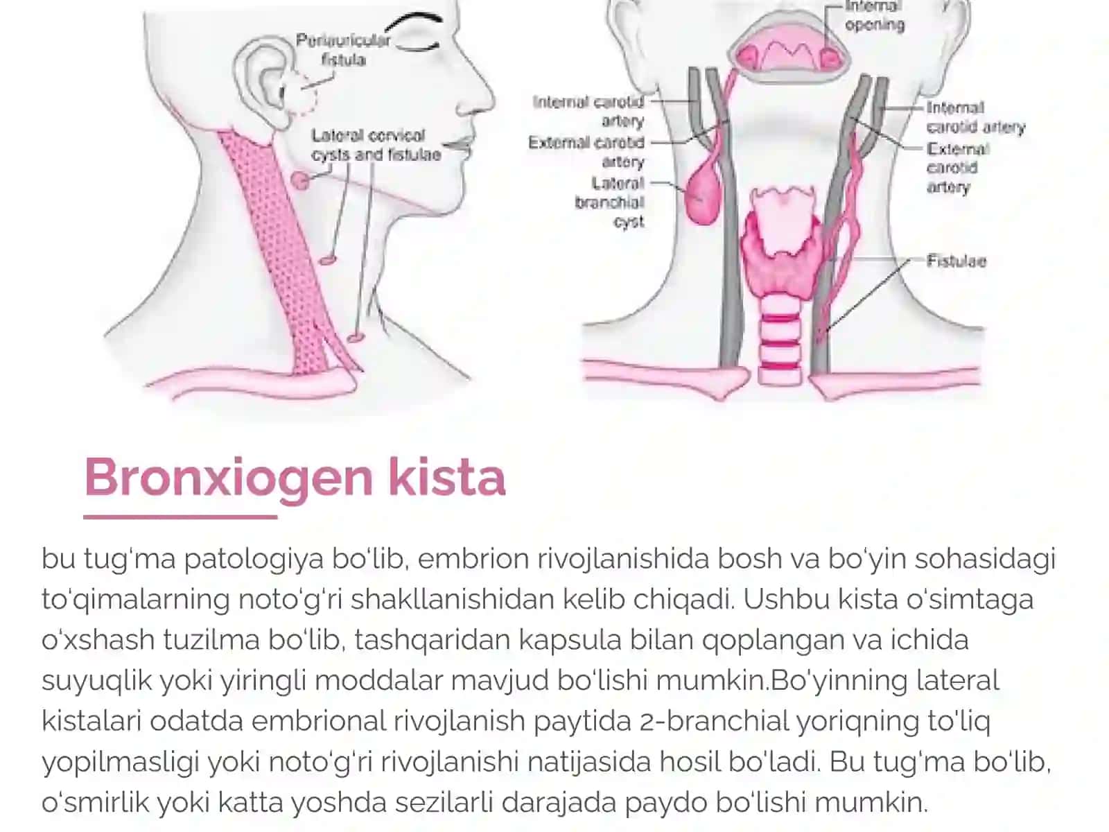 Bo'yinning lateral kistasi 2