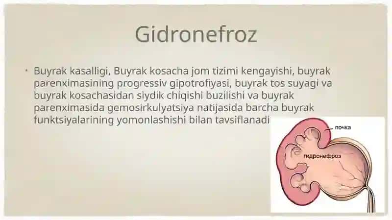 Gidronefroz 2