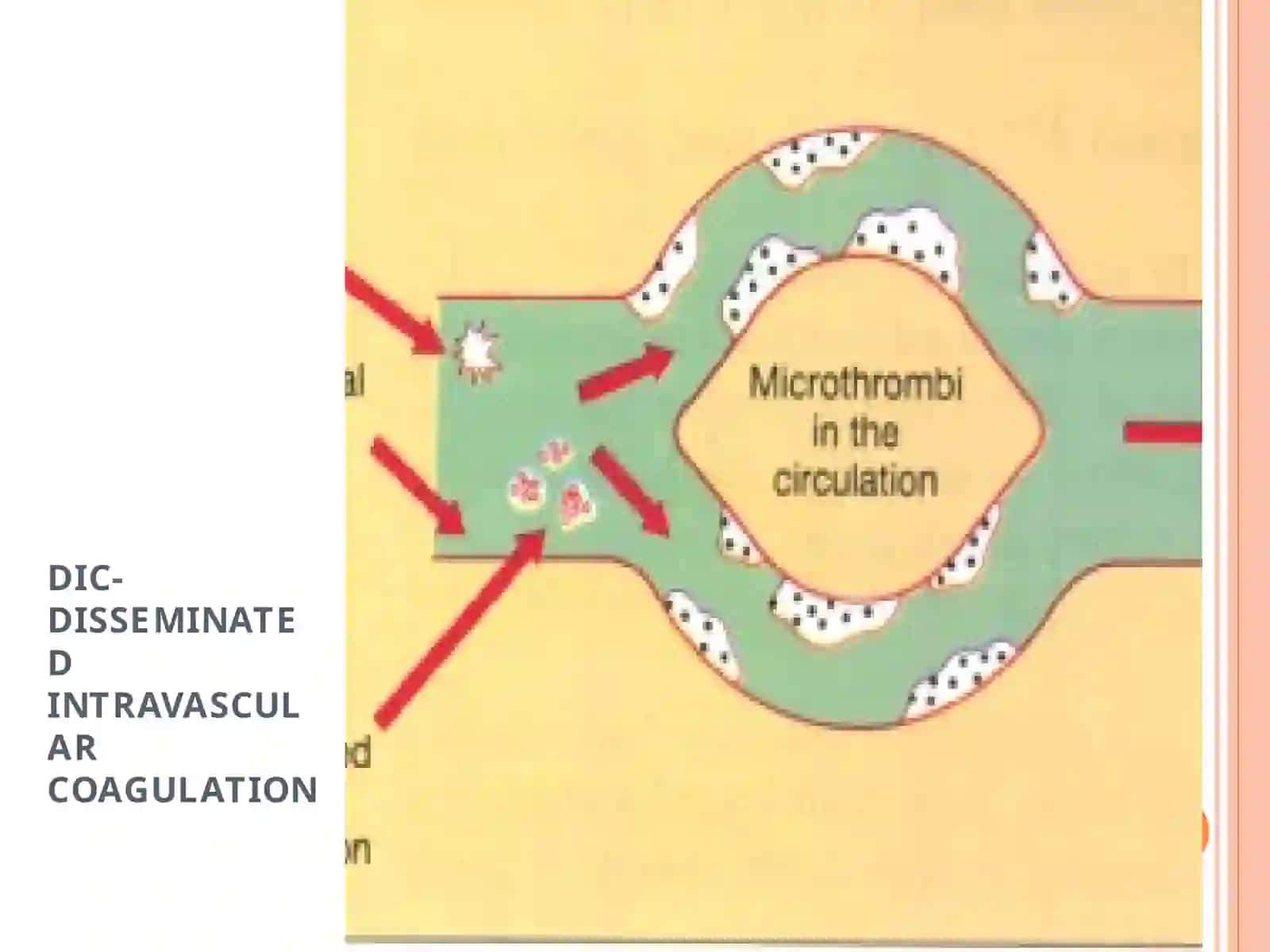 DIC-DISSEMINATED INTRAVASCULAR COAGULATION 2