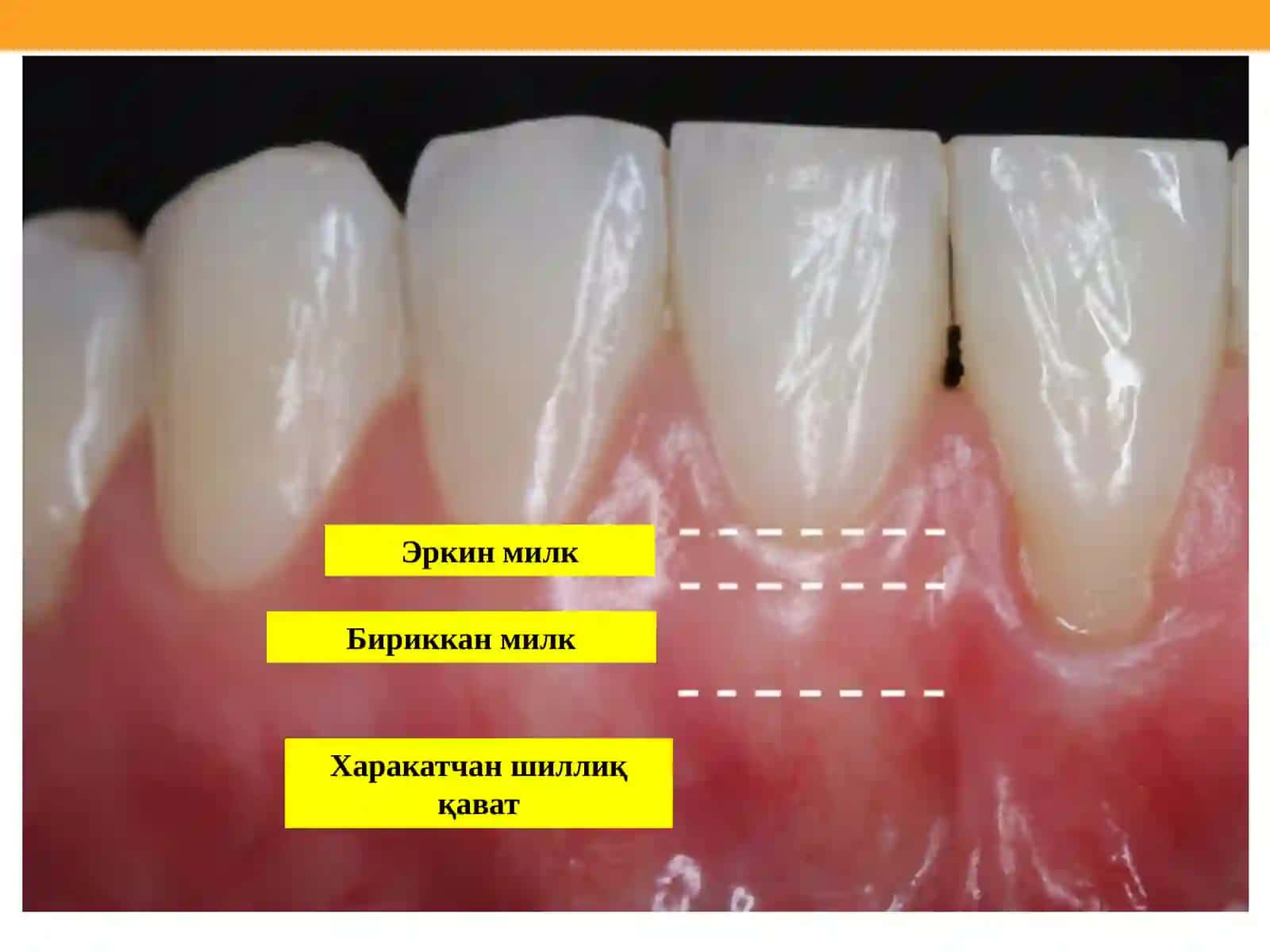 Пародонт касалликлари 2