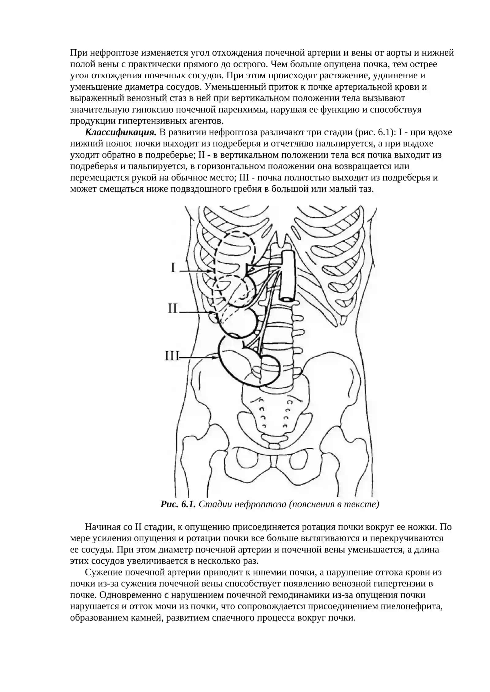 НЕФРОПТОЗ 2
