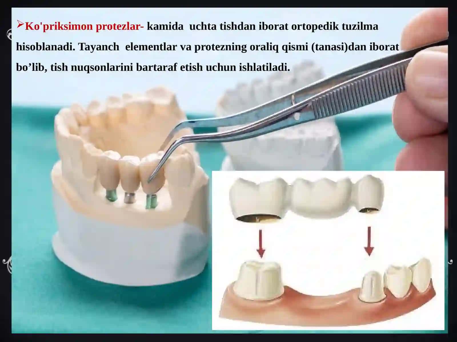 Zamonaviy ko‘priksimon protezlar 2