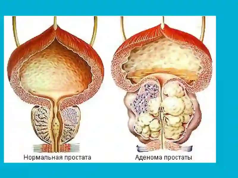 Prostata bezi adenomasi 2