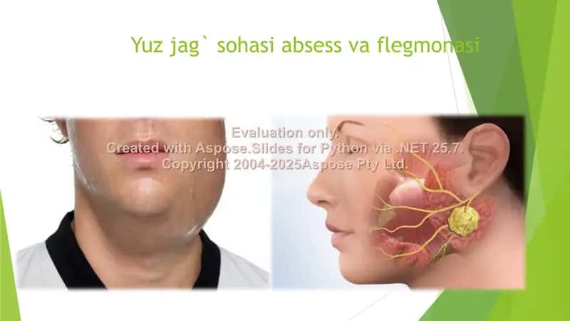Yuz-jag` sohasi absess va flegmonasi 2