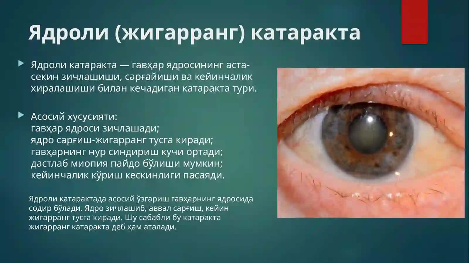 Ядроли катаракта 2