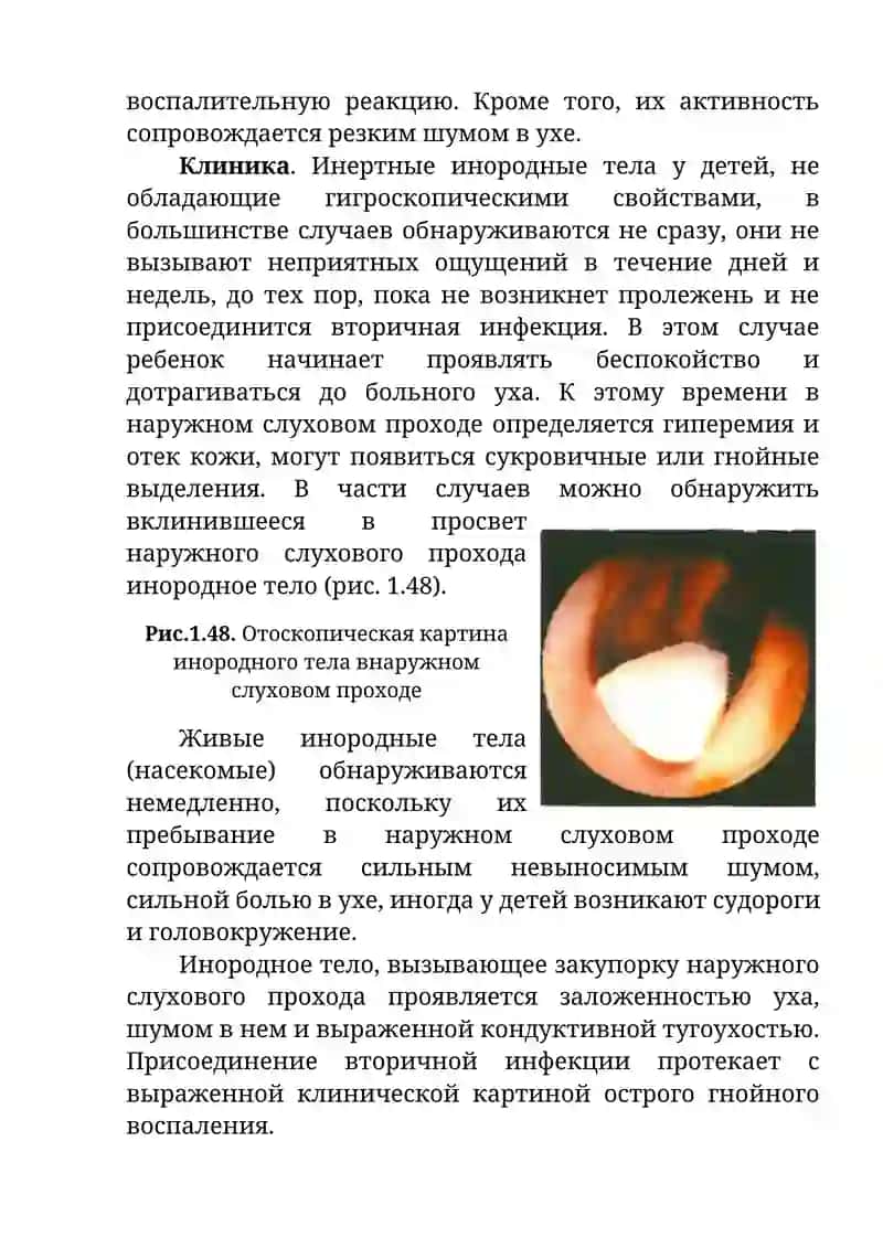 Инородные тела наружного слухового прохода 2