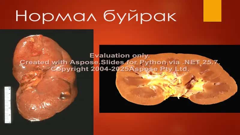 Буйрак касалликлари 2