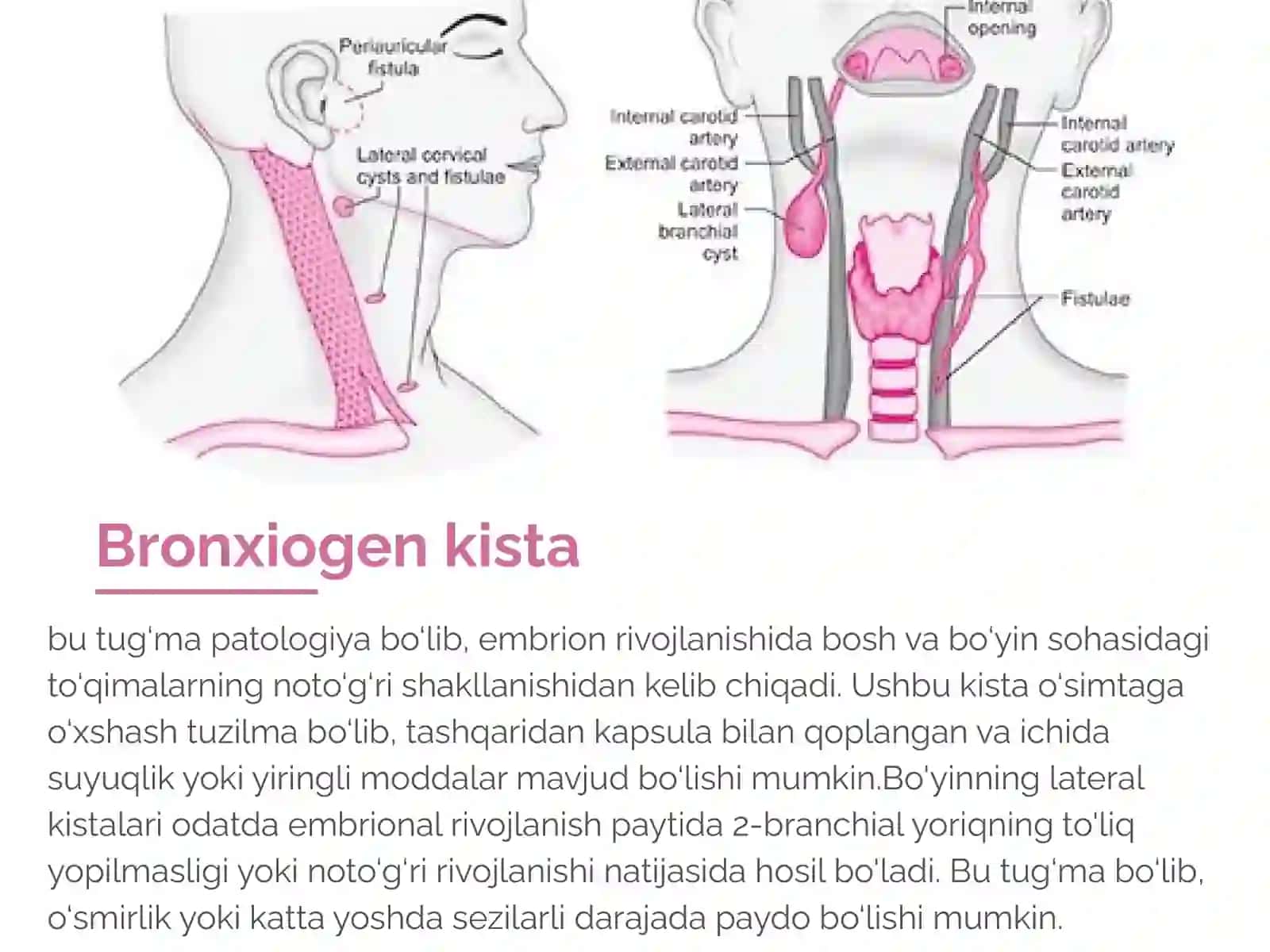 Bo'yinning lateral kistasi 2