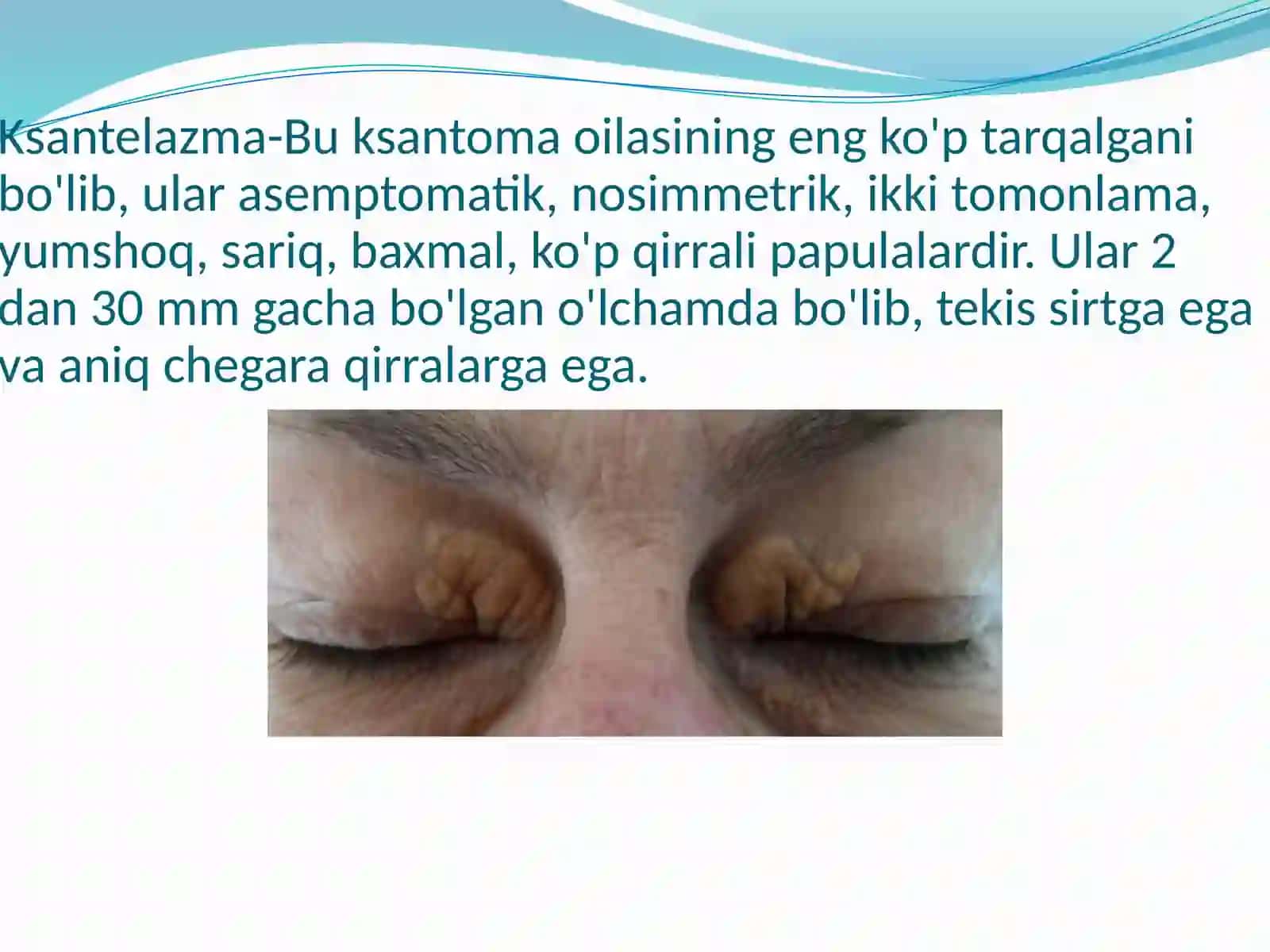 Ksantelazma.Lipoma.Gigroma 2