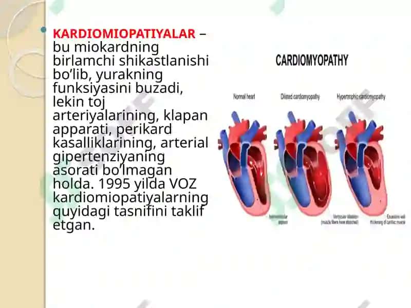 Kardiomiopatiya 2