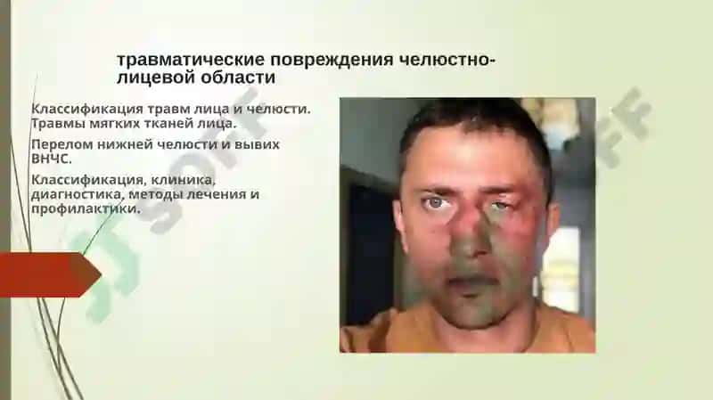 Травматические повреждения челюстно-лицевой области 2