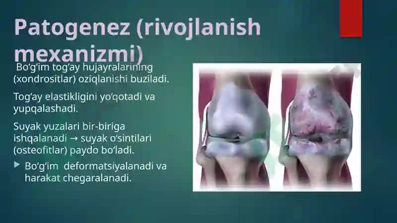 ARTROZ(OSTEOARTROZ) 2