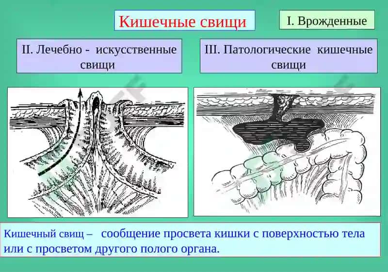 Кишечные свищи 2