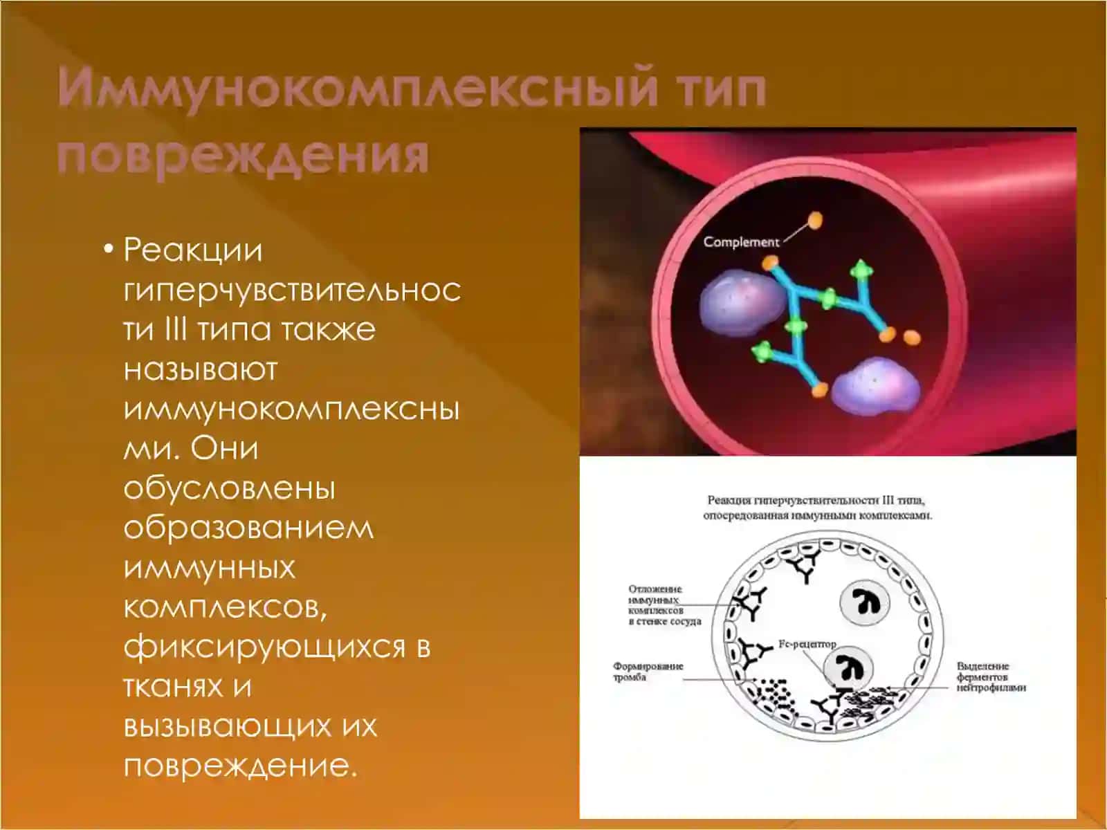 Иммунокомплексный тип повреждения 2