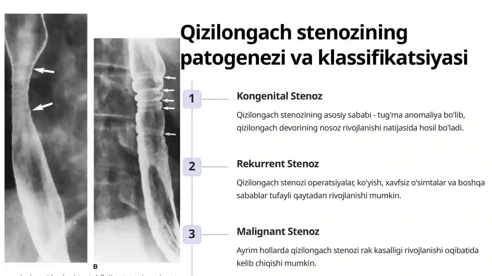 Qizilo'ngach stenozi va atreziyalarida operatsiyalar. Bolalarda traxeya-qizilongach oqimlari operatsiyalari 2