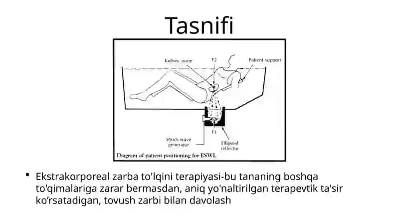 Ekstrokorporal zarb to’lqinli litotripsiya 2