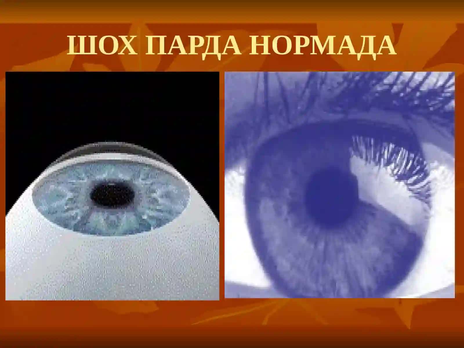 Шох парда патологияси 2
