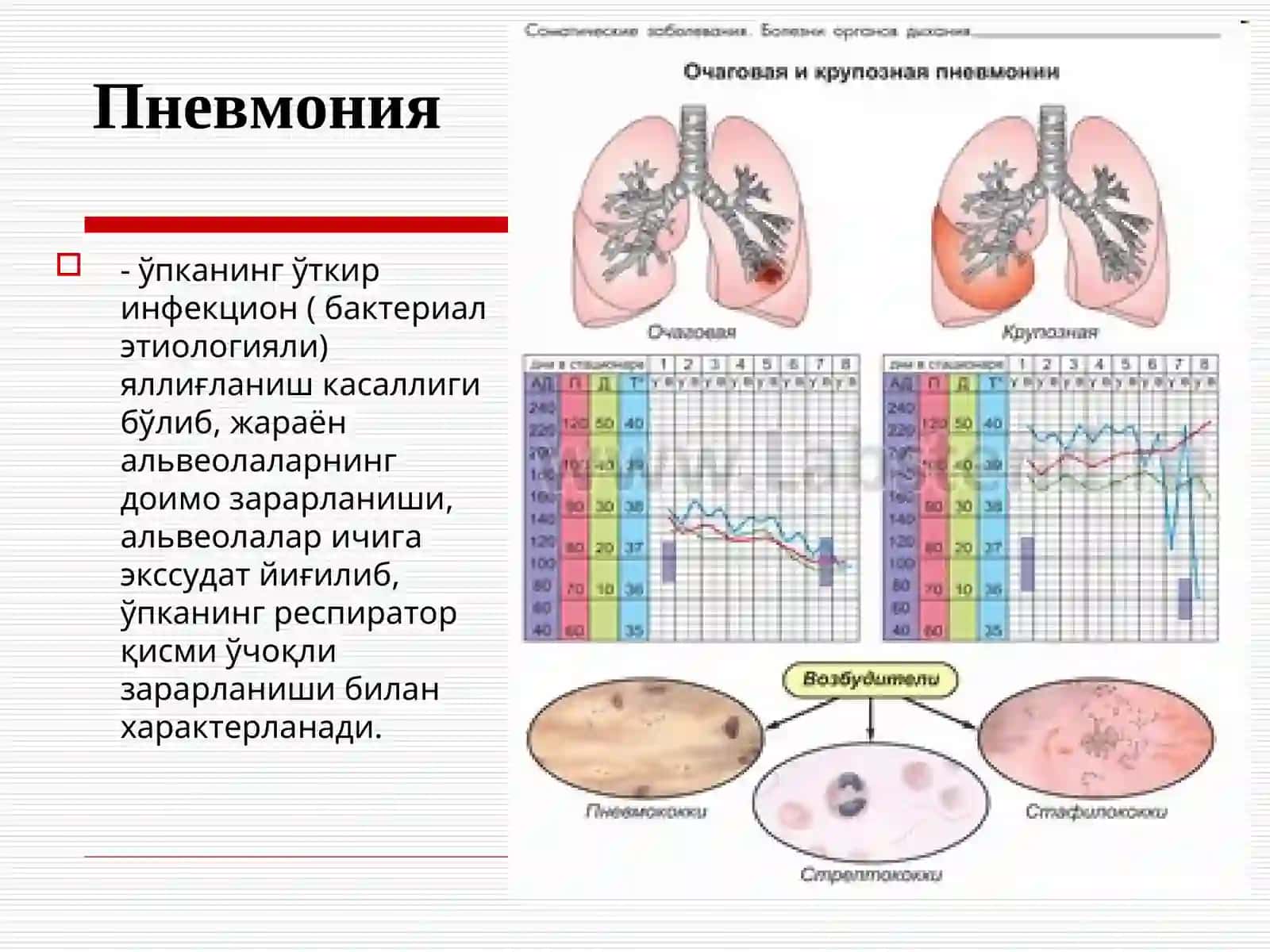 Пневмония 2