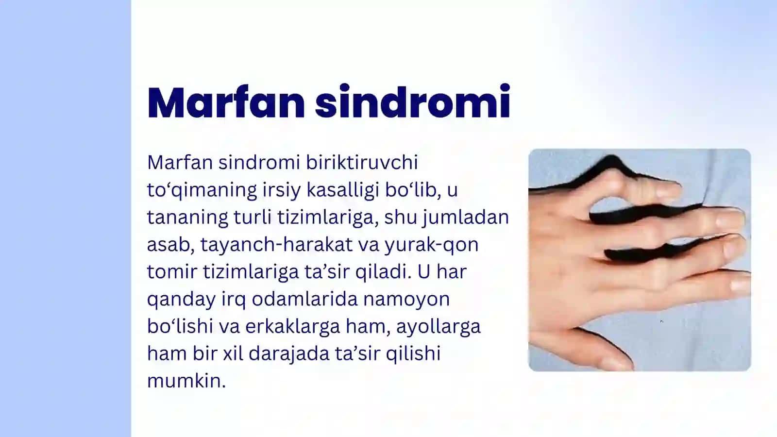 Marfan sindromi 2
