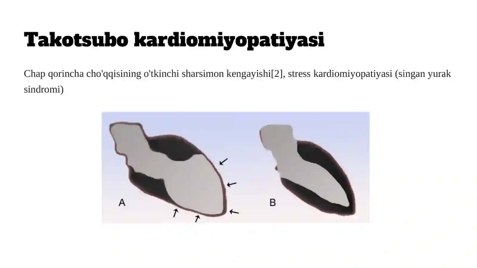 Takotsubo kardiomiopatiyasi (2-variant) 2