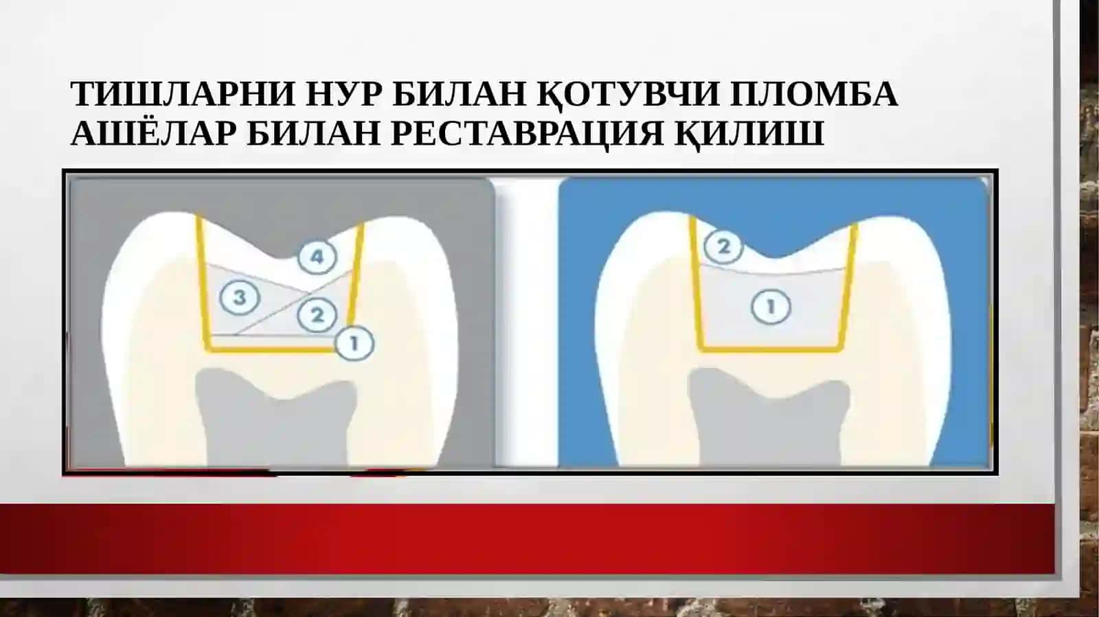 Тишларни нур билан қотувчи пломба ашёлар билан реставрация қилиш 2