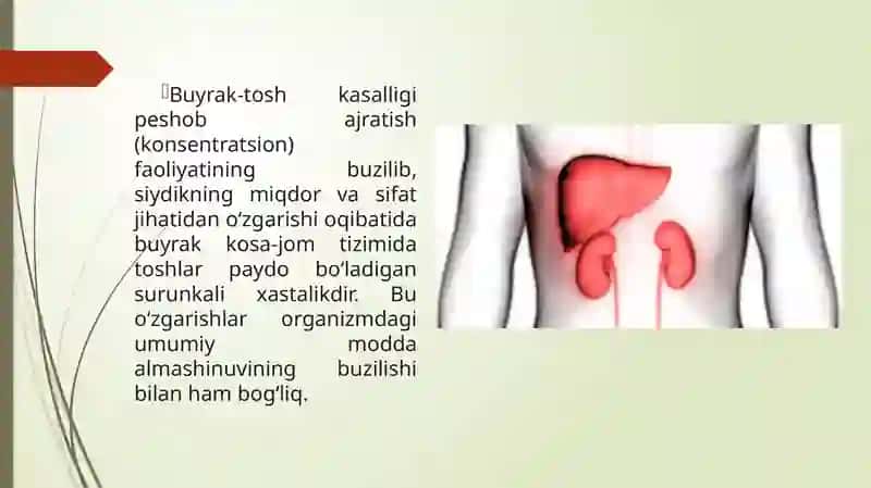 Buyrak    to'sh kasalligi 2