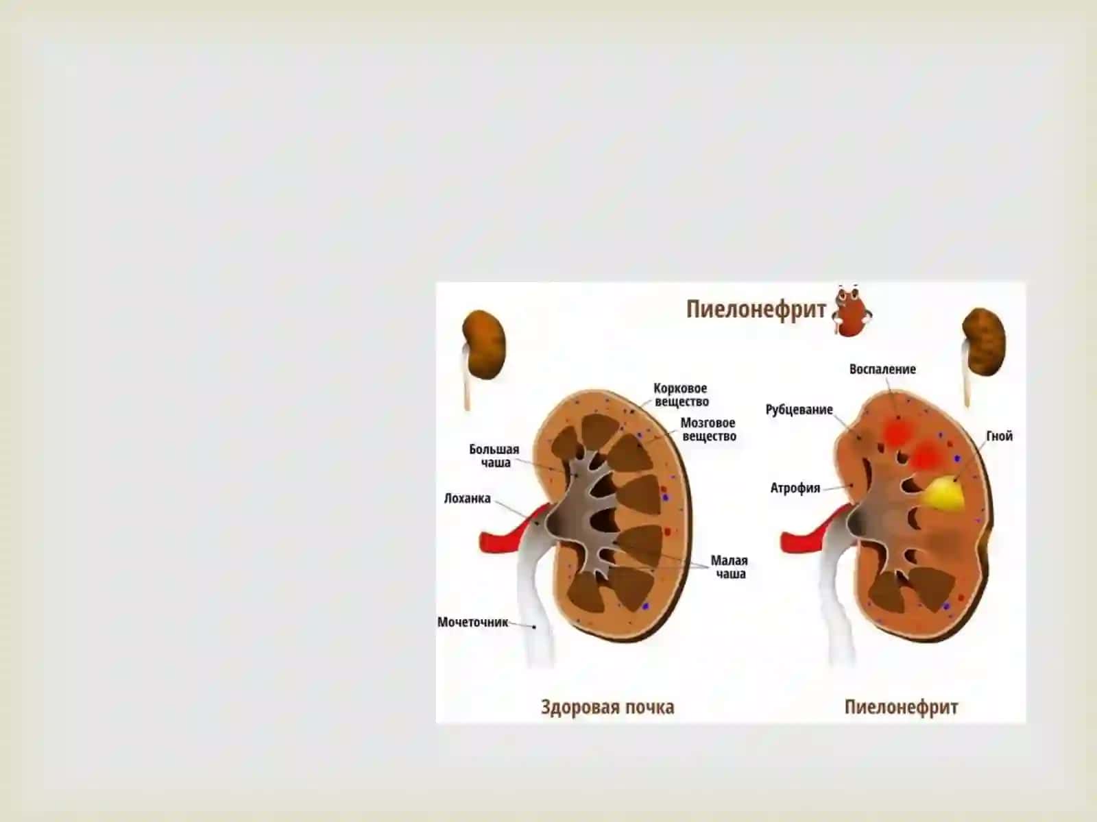 O'tkir piyelonefrit etiologiyasi, patogenezi va tasnifi 2