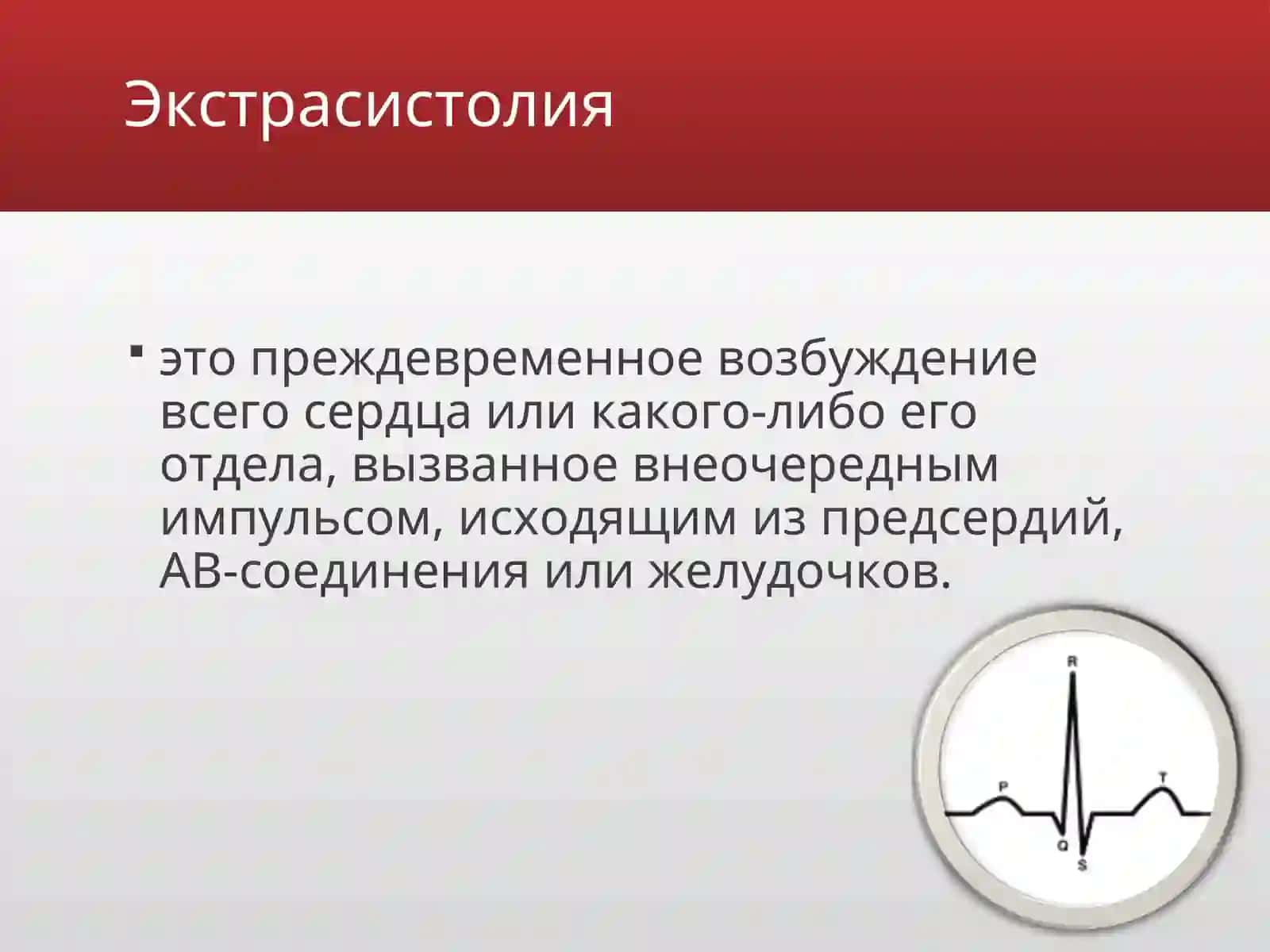 Экстрасистолии 2
