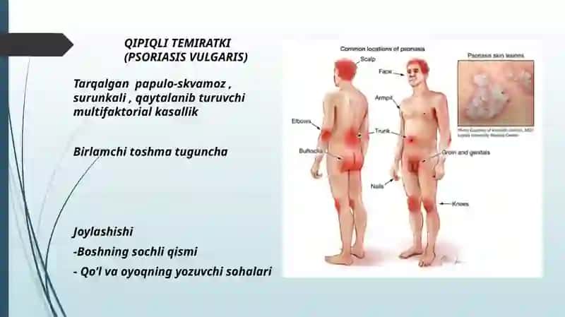 PSORIAZ VA QIZIL YASSI TEMIRATKI QIPIQLI TEMIRATKI (PSORIASISVULGARIS) 2