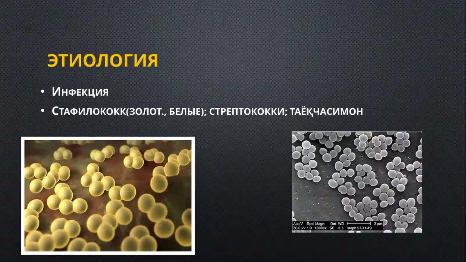 Surunkaliodontogenosteomiyelit 2