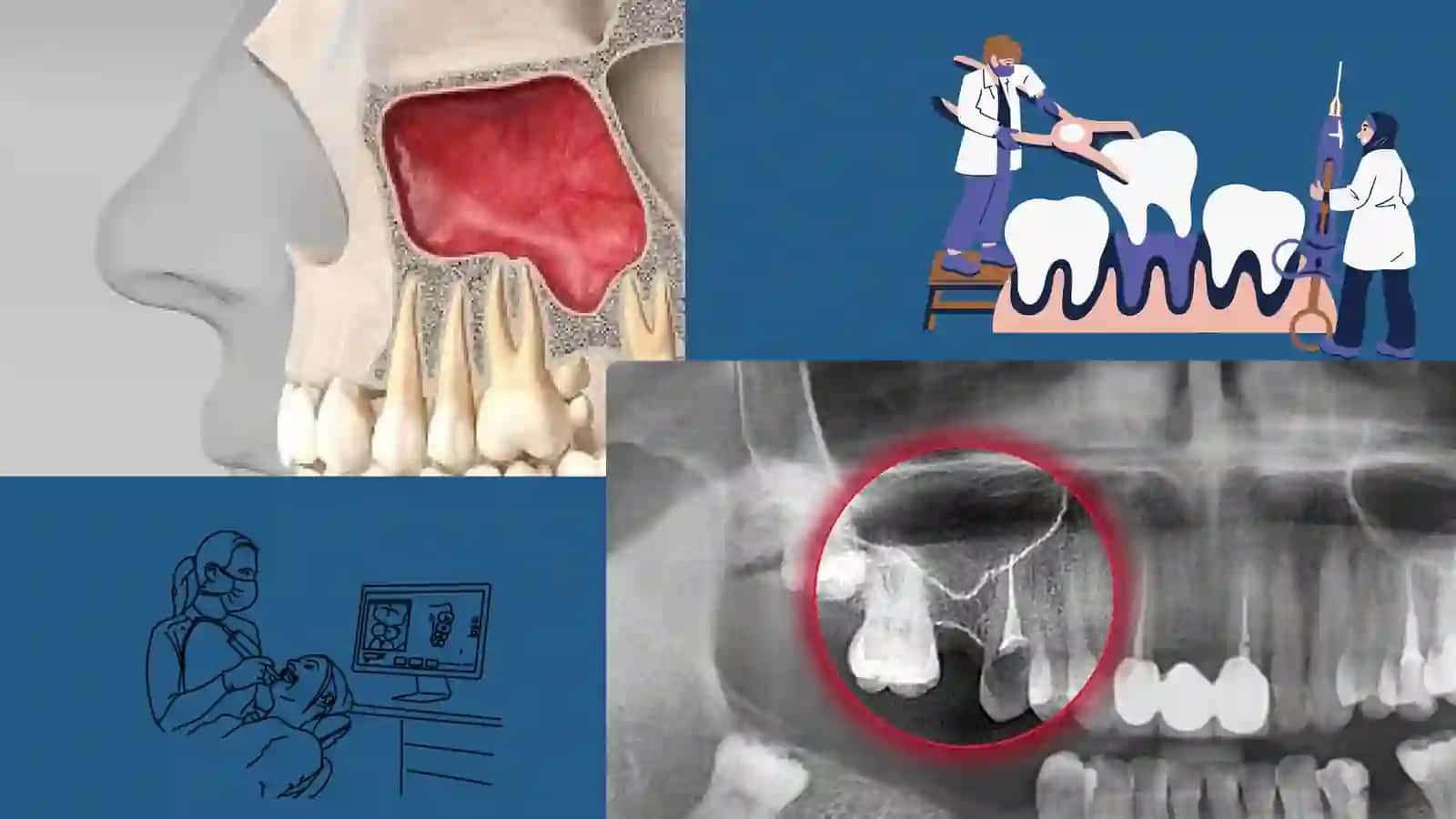 DENTAL IMPLANTATSIYADA YUQORI JAG’DA O’TKAZILADIGAN QO’SHIMCHA OPERATSIYALAR ; SINUSLIFTING , AUGMENTATSIYA 2
