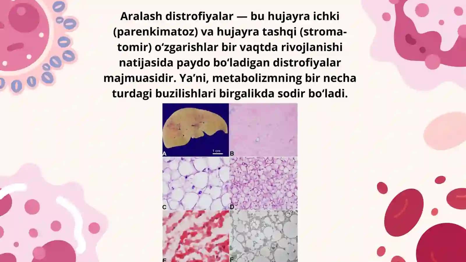 ARALASH DISTROFIYA 2