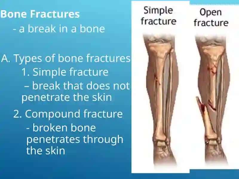 Bone Fractures 2