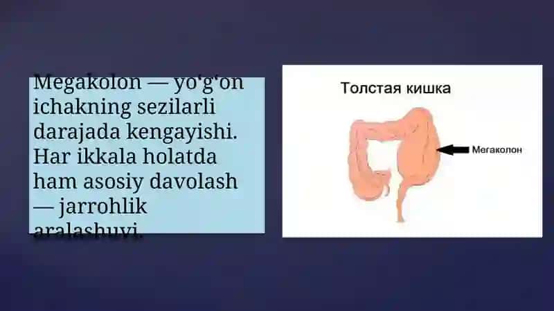 Megakolon va Grishprung kasalligida operatsiyalar 3
