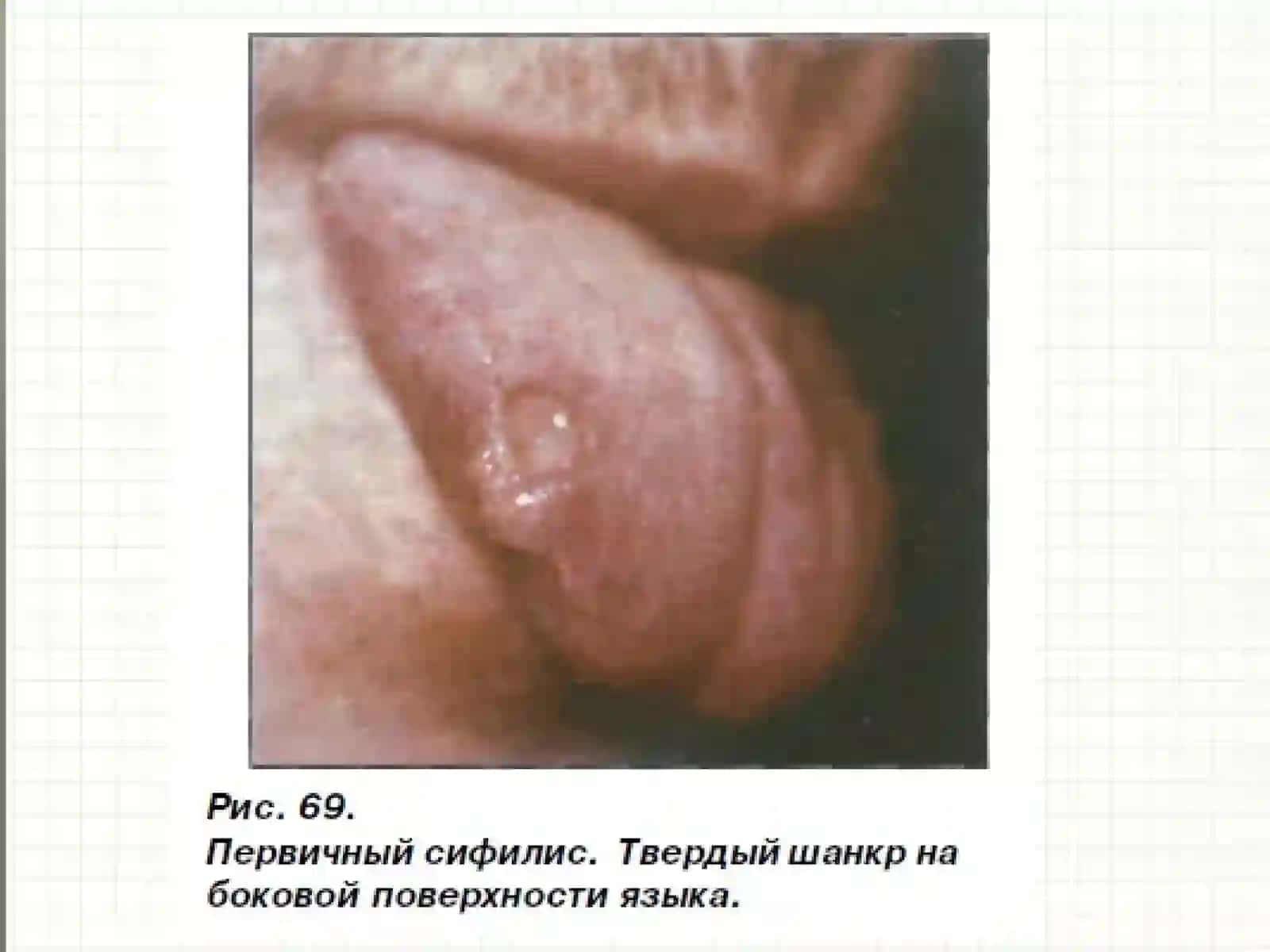 SIFILIS (LUES, SYPHILIS) 3