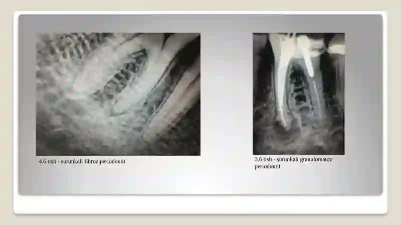Periodontit 3