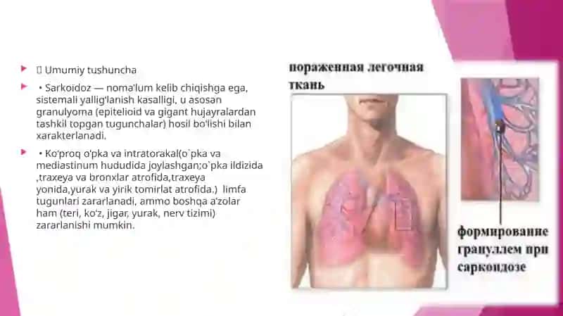 Pulmonologiya mavzu: O`pka sarkaidozi 3