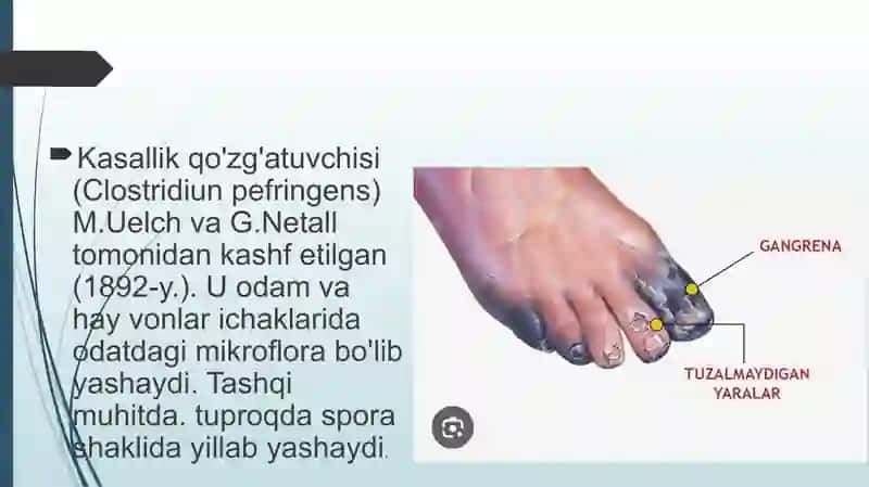 Gazli Gangrena 3
