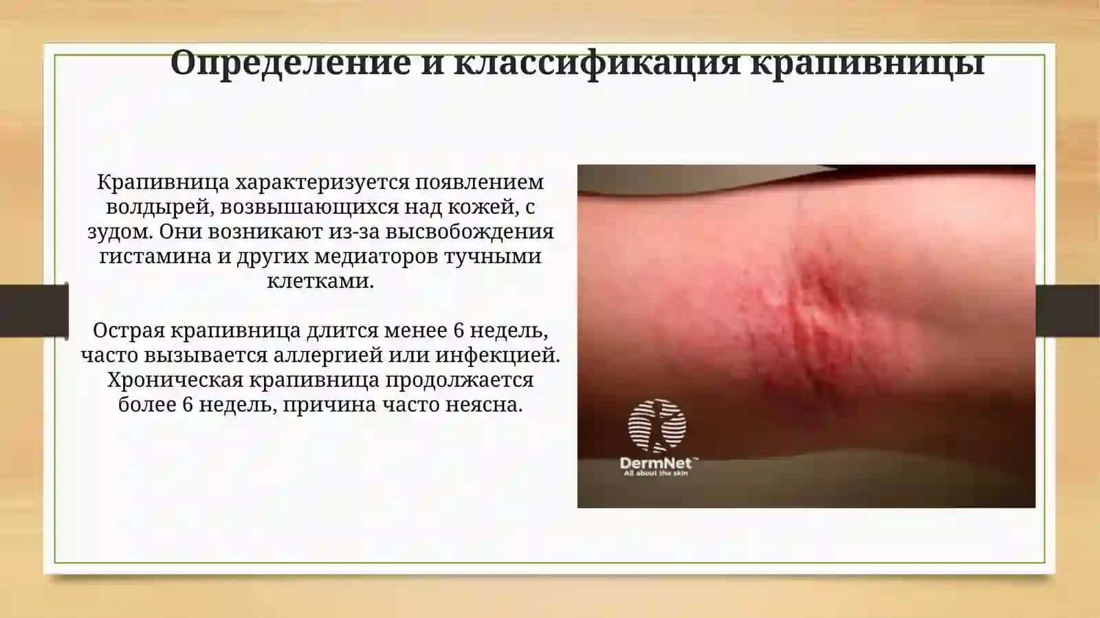 Крапивница и атопический дерматит: Клиническая картина и диагностика 3