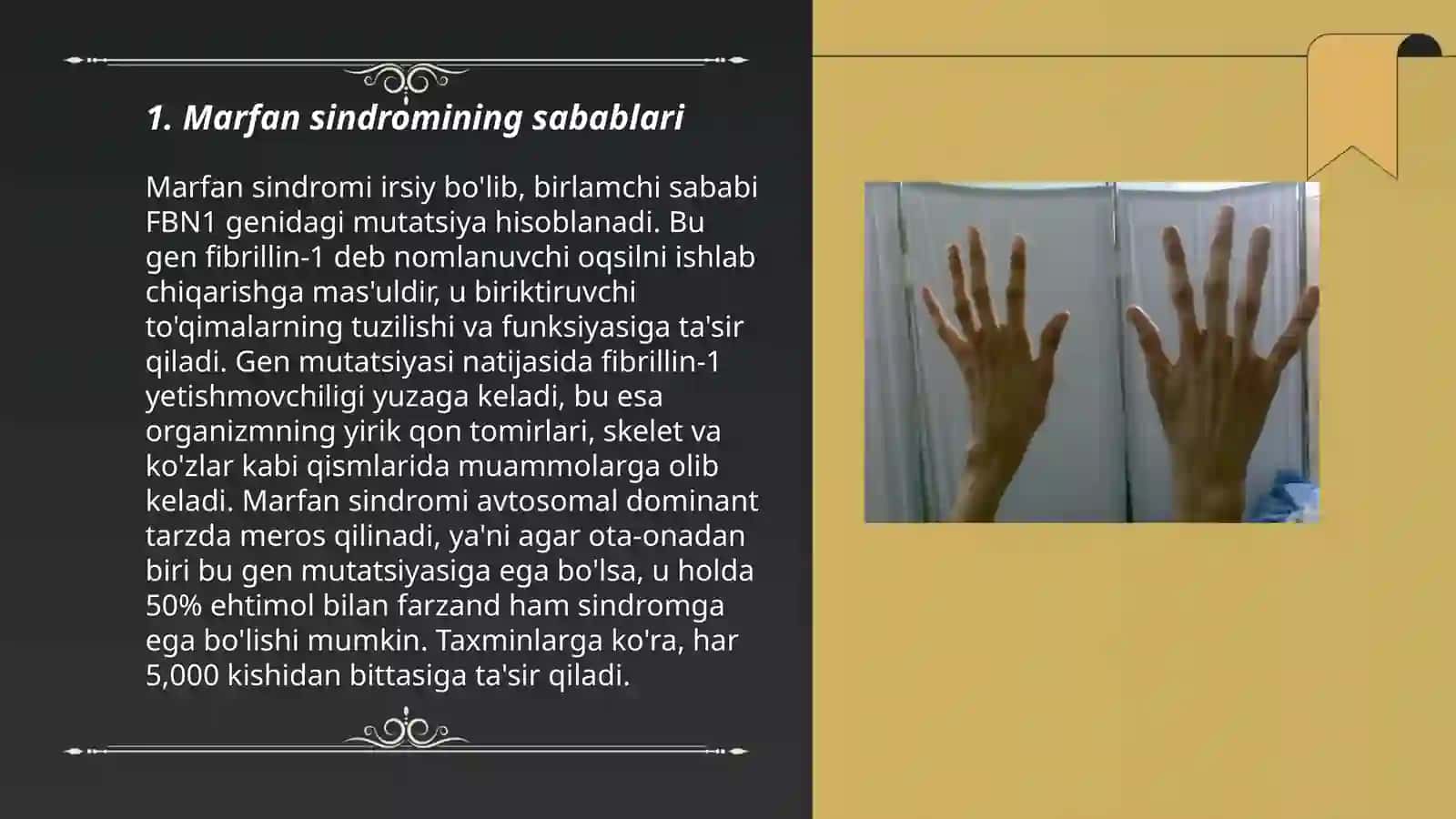 Marfan sindromi 3