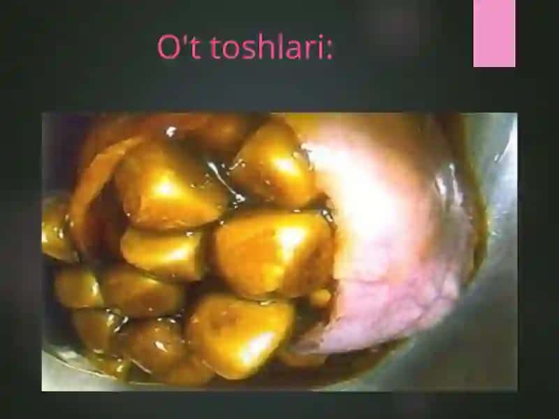 O'T-TOSH KASALLIGI 3