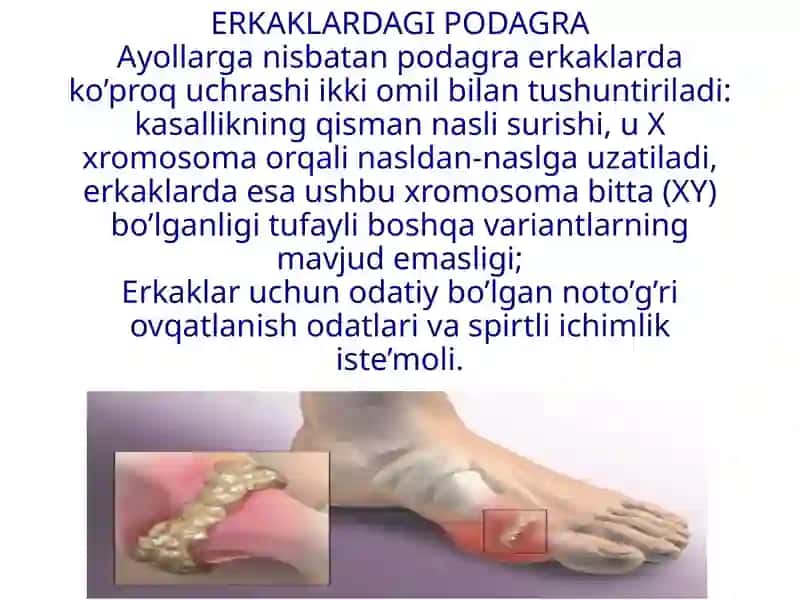 Giperurikemiya va podagra 3