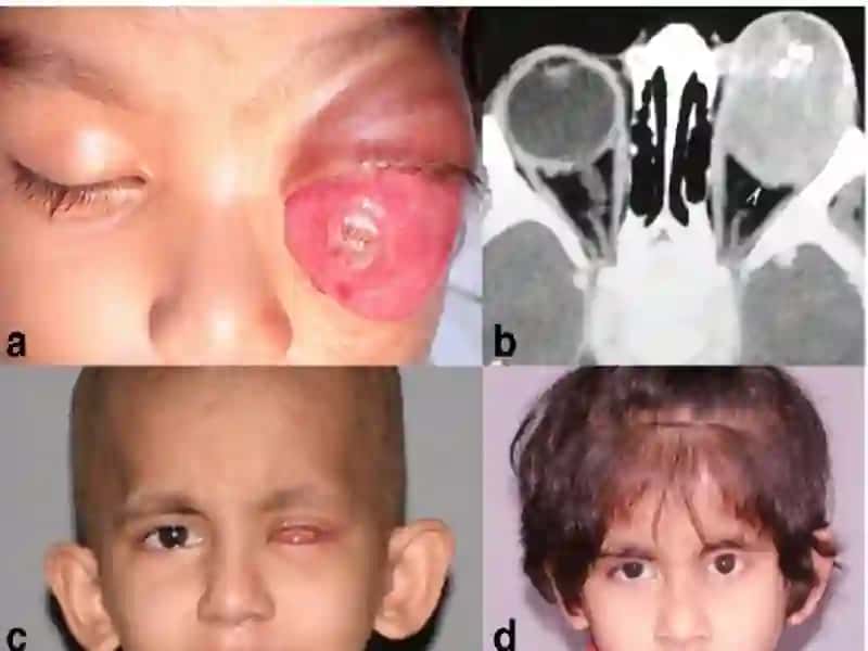Retinablastomalar 3