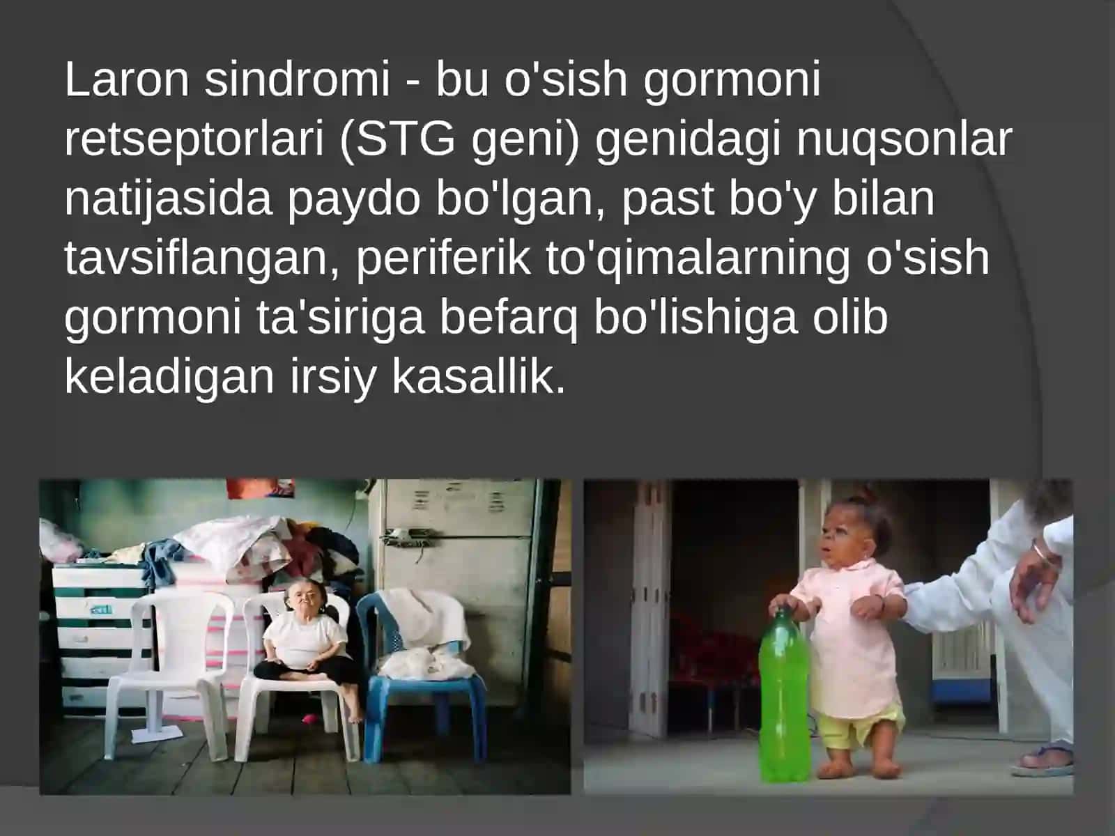 Laron sindromi 3