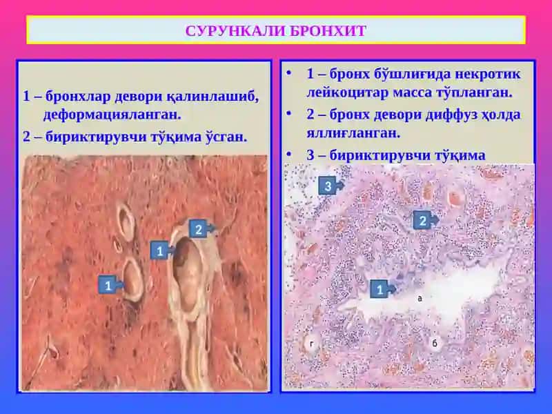 СУРУНКАЛИ БРОНХИТ 3
