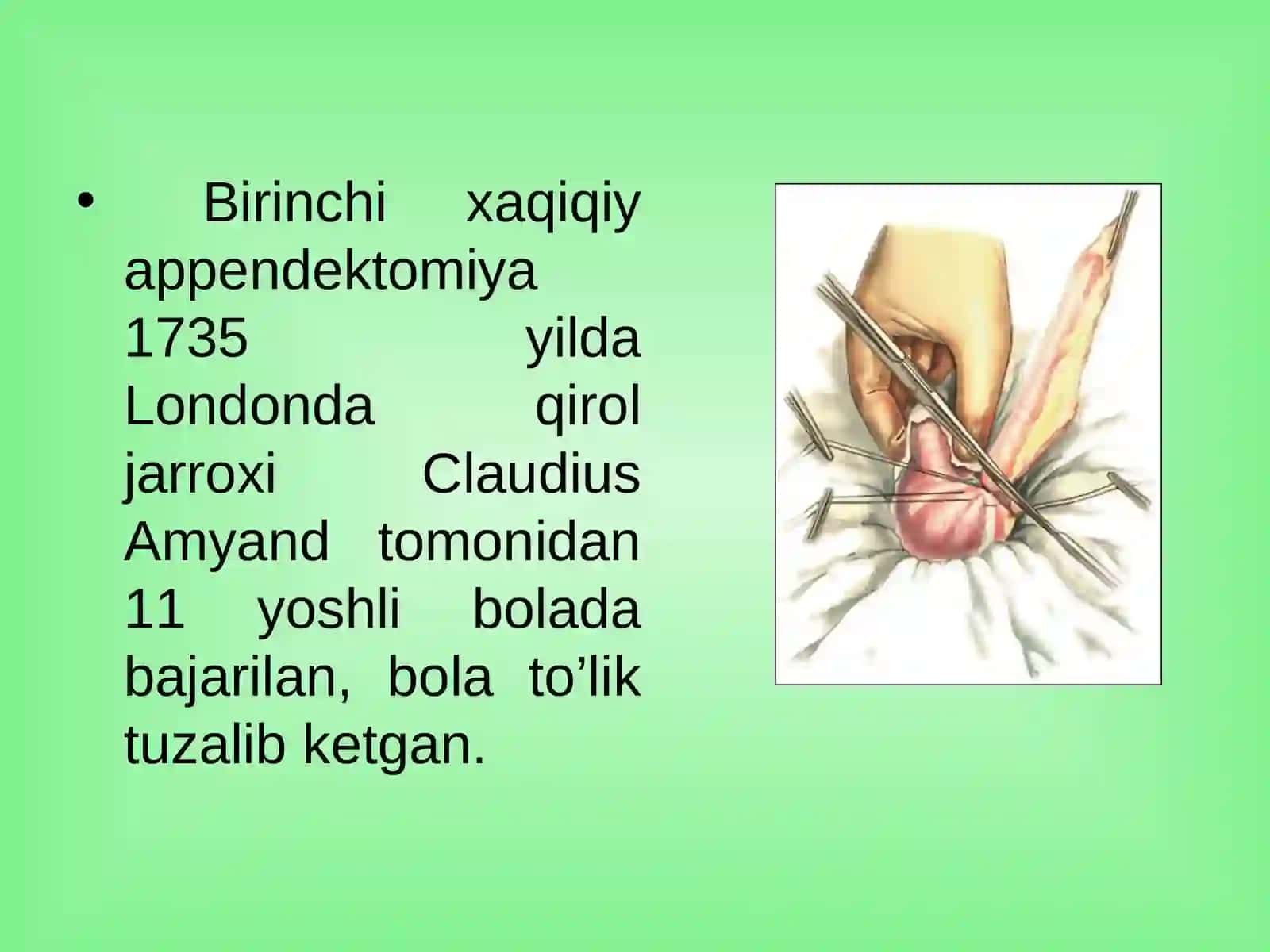 O’tkir appenditsit. 3