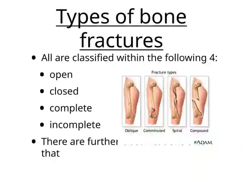 Fractures 3