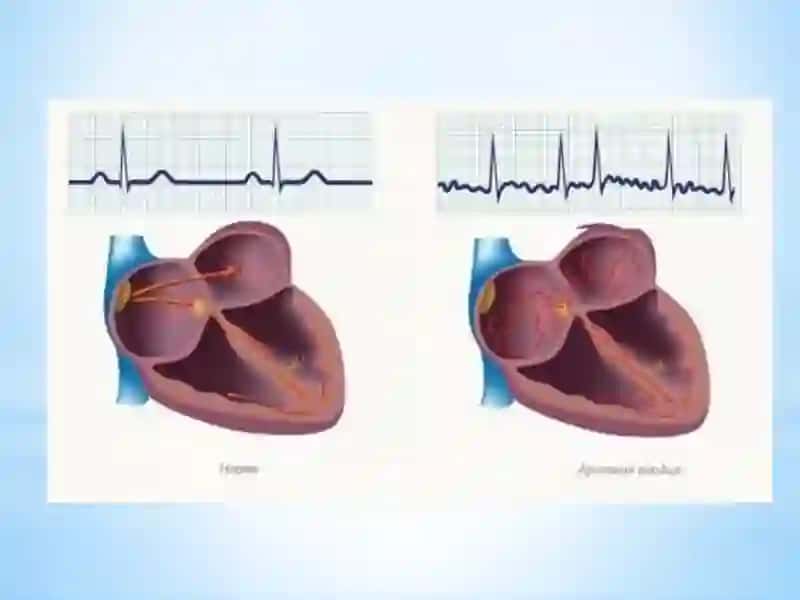 Aritmiya 3